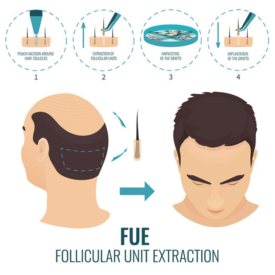 FUE hair transplants