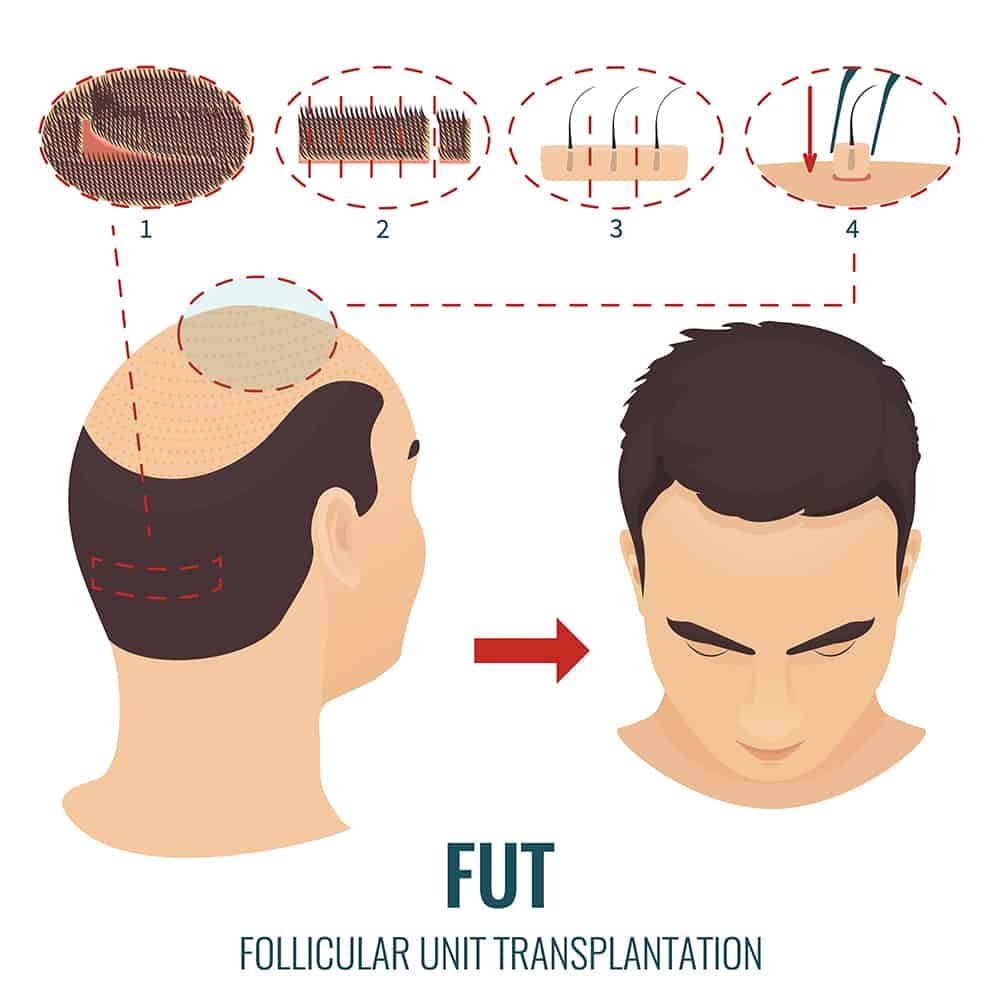 FUT hair transplants