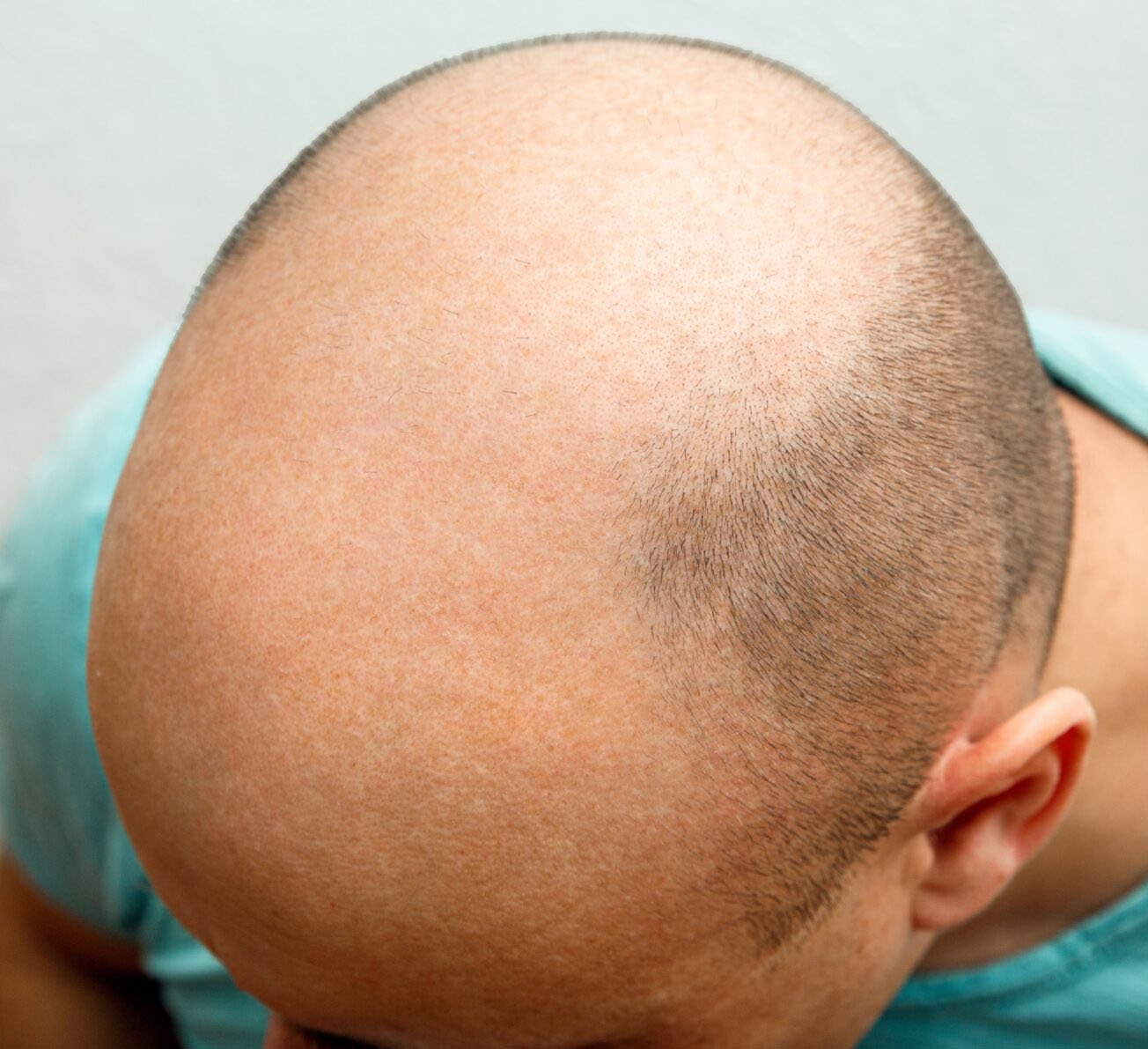 hair transplants